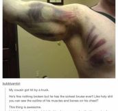 Epic Bruise