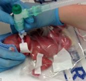 The tiny baby saved by a sandwich bag: Incredible survival of 1lb girl who was born three months early