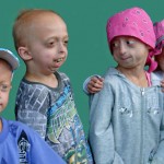 progeria-syndrome
