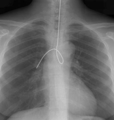 tube in lungs 10 Most Horrible Medical Mistakes Made by Doctors