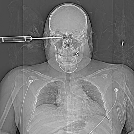 fat stab 550x550 The 5 Worst Things Found By X Ray Technicians