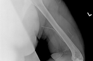 teenage metal 1211 The 5 Worst Things Found By X Ray Technicians