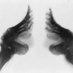foot-binding2