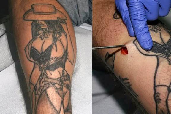 Breast Implant on Legs 2 Man Gets Breast Implants for Legs to Complete Tattoo