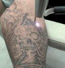 Laser tattoo removal...