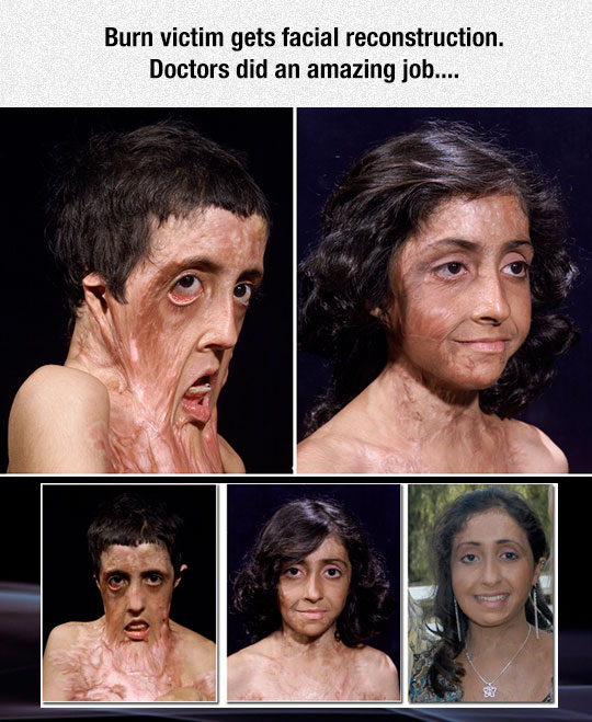cool-burnt-victim-facial-reconstruction