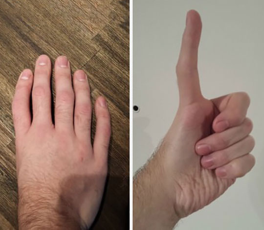 Five Fingers, No Thumb