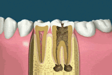 Ever Seen A Root Canal Surgery?